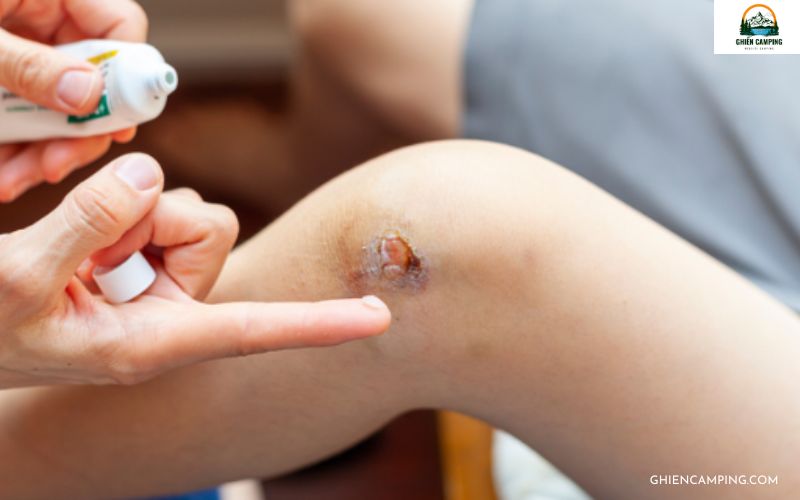 Những cách xử lý chấn thương khi cắm trại mà bạn cần biết 7 Dùng dung dịch sát khuẩn để làm sạch, bôi thuốc sát trùng