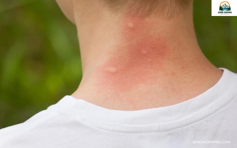 Những cách xử lý chấn thương khi cắm trại mà bạn cần biết 9 Hãy luôn mang theo thuốc chống côn trùng và sử dụng thường xuyên
